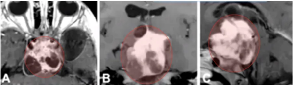 年仅2岁的儿子，从确诊胶质瘤到顺利开颅手术，每一步我们都是怎么走过来的
