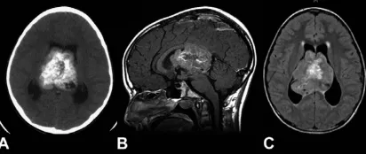 从病危到6年无复发，12岁室管膜瘤男孩「一波三折」的治疗之路