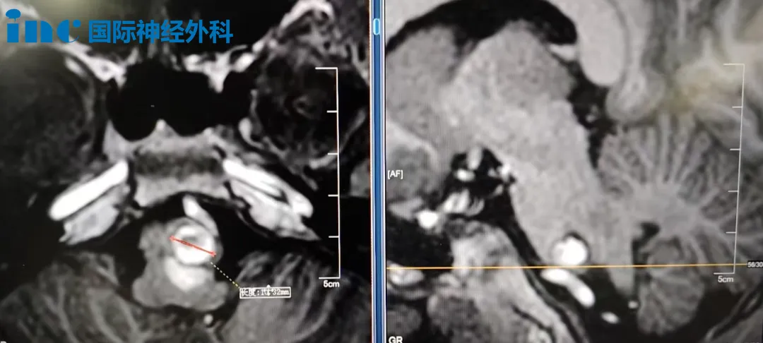 脑干海绵状血管瘤切除术