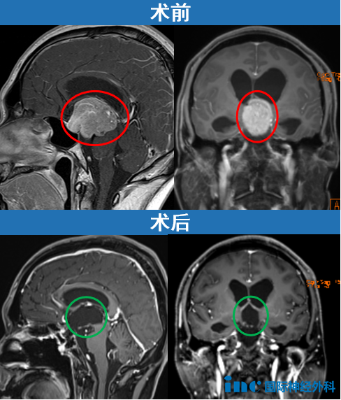 没有开颅，INC福教授在北京天坛医院最终通过经鼻内镜手术成功切除了这个巨大的垂体瘤。