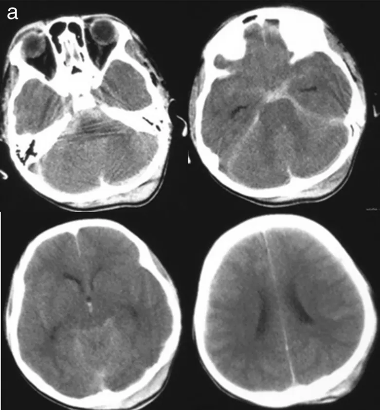 一场车祸，两重劫难：8岁男孩闯过急救关后又因颅内创伤性动脉瘤命悬一线！