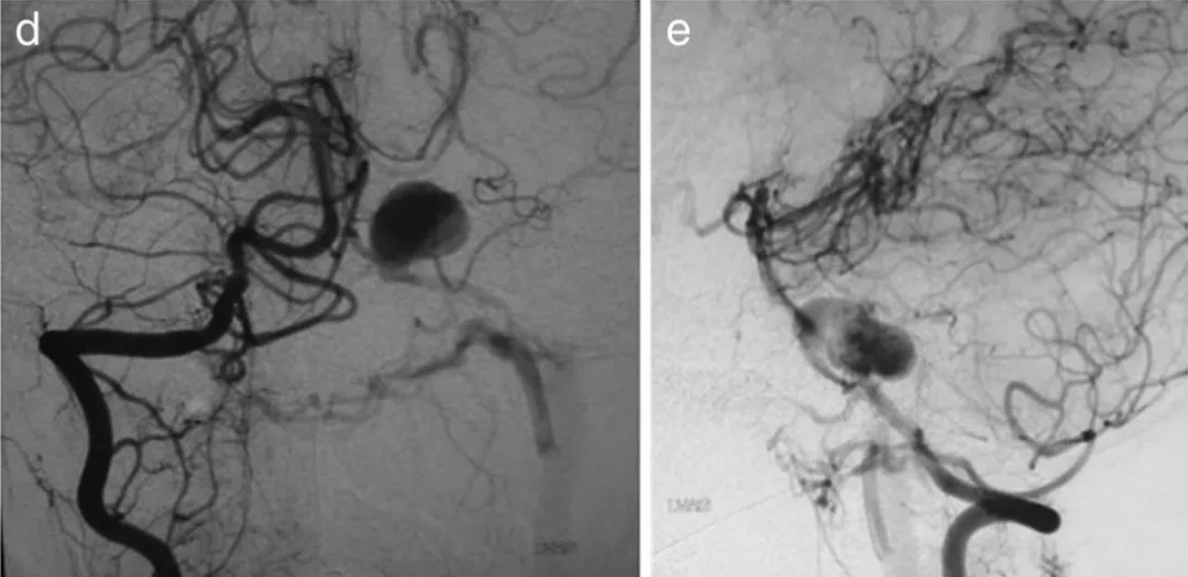 图d，e为第14天右椎动脉造影。动脉瘤扩大，房室瘘更加明显。