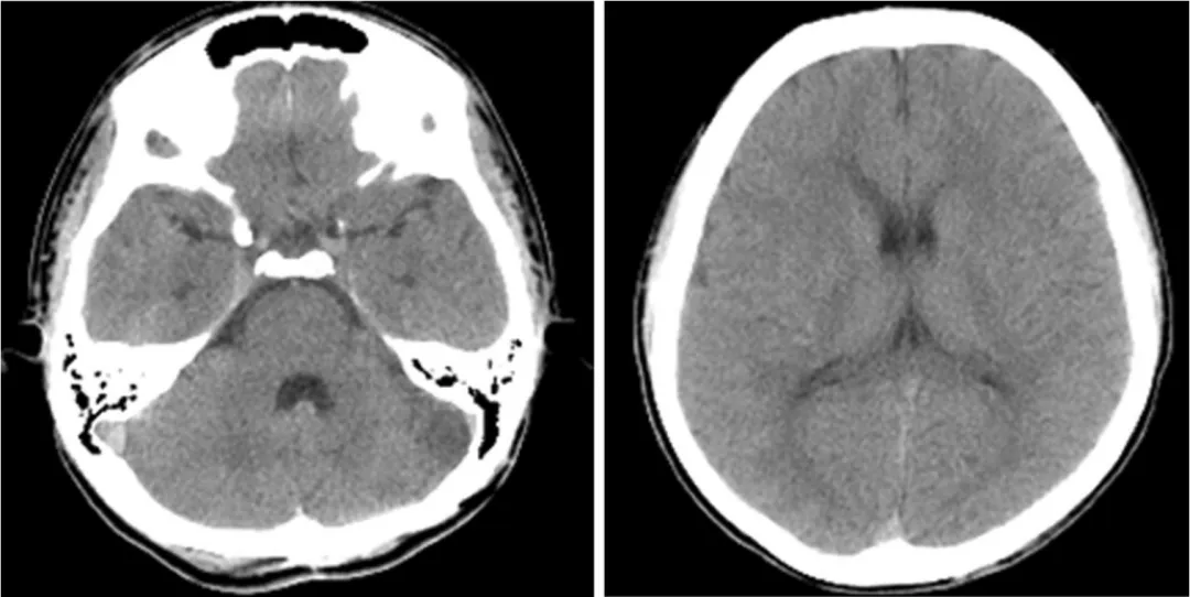 术后CT，无明显缺血性病变或<a href='/naojishui/' target='_blank'><u>脑积水</u></a>