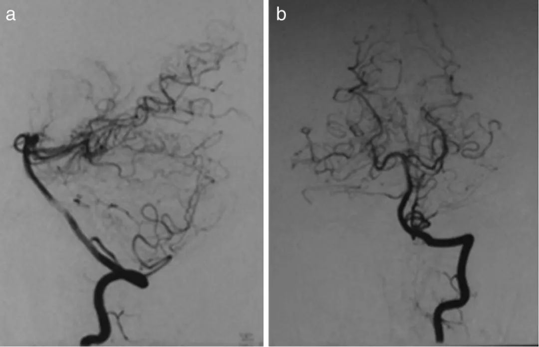 术后血管造影显示无残余动脉瘤或房室瘘