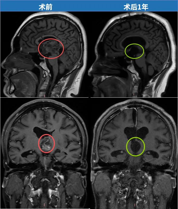 术后近5个月随访，巴教授表示：“对于这个毛细胞型星形细胞瘤，实现了全切除。