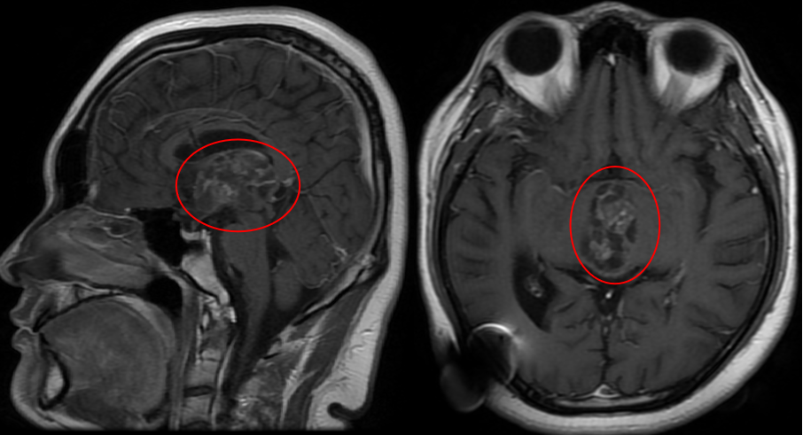 MRI显示，一颗40毫米的巨大肿瘤已占据第三脑室