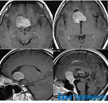 2025年末，武女士的右侧视野同样出现明显缺损，记忆力也大不如前。