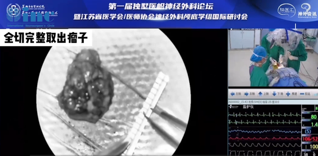 阿朔手术直播中，在术中神经电生理监测下，巴教授顺利全切取出肿瘤