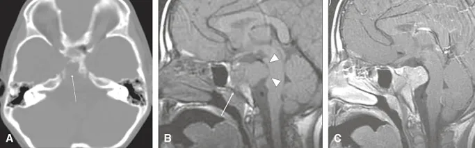 平扫CT（图1A）显示斜坡广泛骨质破坏，病灶位于斜坡中心（箭头），无骨性或软骨样基质。磁共振成像（MRI）显示病灶信号均匀，平扫T1加权像呈等信号（图1B），T2加权像呈低信号。病灶呈均匀强化（图1C）。