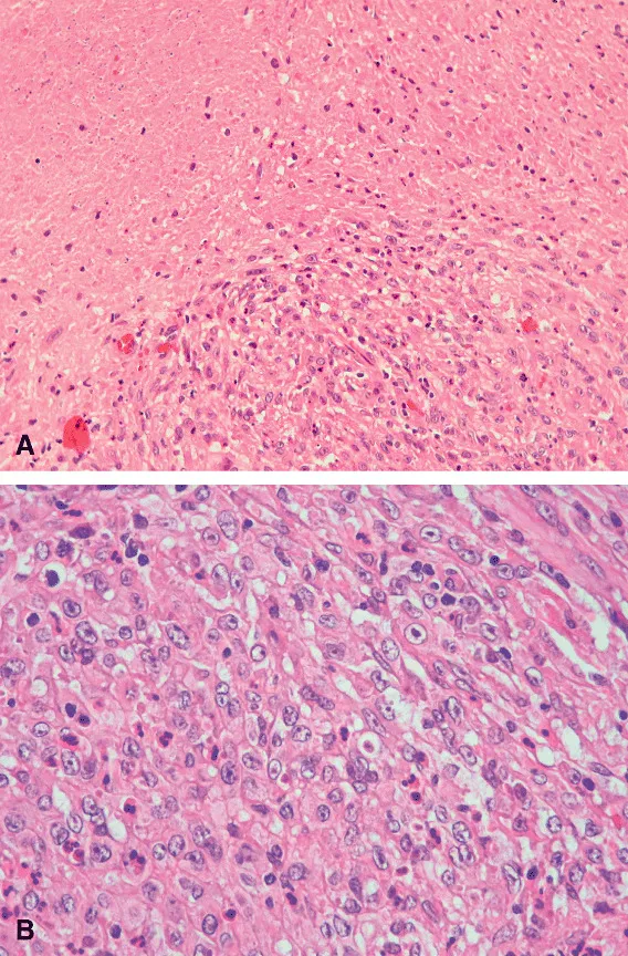 肿瘤细胞形成结节状聚集，由纤维炎性间质分隔。可见多处地图样坏死区域（图2A）。