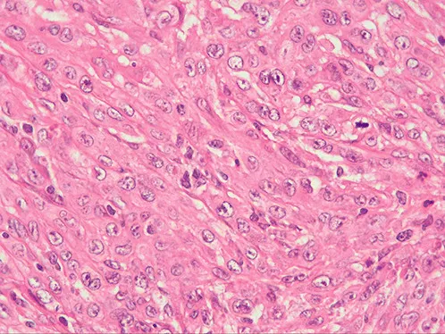组织病理学检查显示肿瘤由梭形细胞和横纹肌样细胞构成，细胞胞浆丰富、嗜酸性，核圆形，核仁明显，可见大量核分裂象