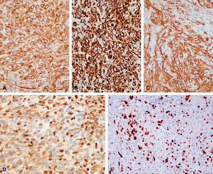 免疫组织化学染色显示，肿瘤细胞表达波形蛋白（图4A）、细胞角蛋白8/18、细胞角蛋白AE1/AE3（图4B）和上皮膜抗原（EMA）（图4C）。胶质纤维酸性蛋白（GFAP）、S-100、胎盘碱性磷酸酶、甲胎蛋白、CD-117、CD-34和CD-31均未表达。BAF-47抗体（INI1失活）免疫组化染色显示肿瘤细胞核不表达，而炎性细胞和成纤维细胞核正常表达（图4D）。Ki67抗体评估的增殖指数超过40%（图4E）。
