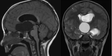 拉拉竟被查出了一个骇人的<a href='/naoliu/' target='_blank'><u>脑瘤</u></a>