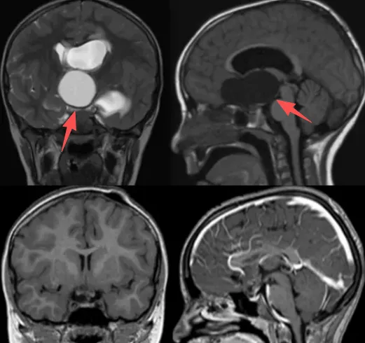 鲁特卡教授及团队通过插入VP分流器和Ommaya囊来实现，并在不断拍打Ommaya储液囊后，效果十分明显——拉拉的颅咽管瘤肉眼可见地缩小，甚至几乎消失无踪！