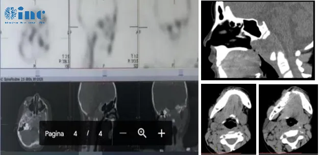 枕骨斜坡区骨质破坏，需鉴别朗格汉斯细胞组织增生症（LCH）或脊索瘤的可能