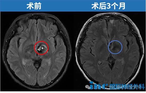 术后第8天，当巴教授再次查房时，文文的家人开心地说：“她已经能自己下地走路了”