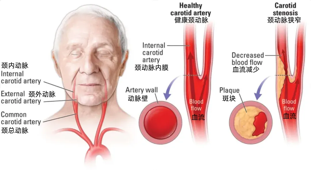 什么是颈动脉狭窄？