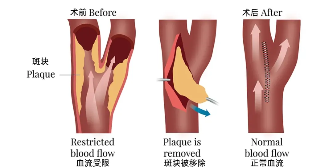 颈动脉内膜剥脱术（CEA）