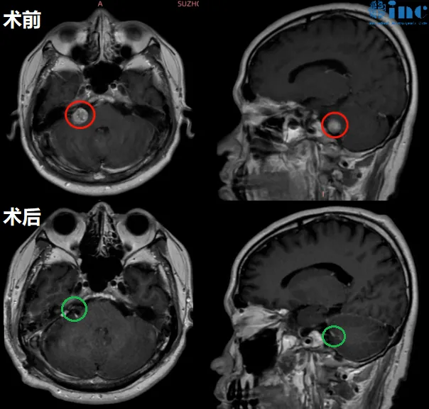 巴教授采用 “内听道磨除术 + 膜内切除术”，成功切除肿瘤并完好保留面听神经功能。