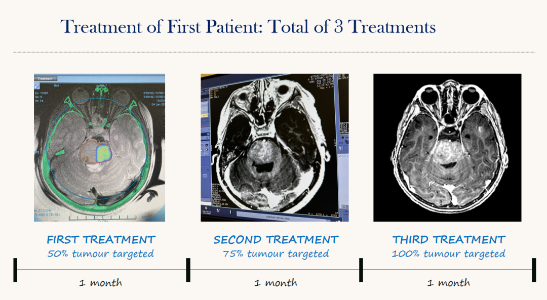 世界首例磁共振引导聚焦超声（MRgFUS）为儿童脑肿瘤提供化疗