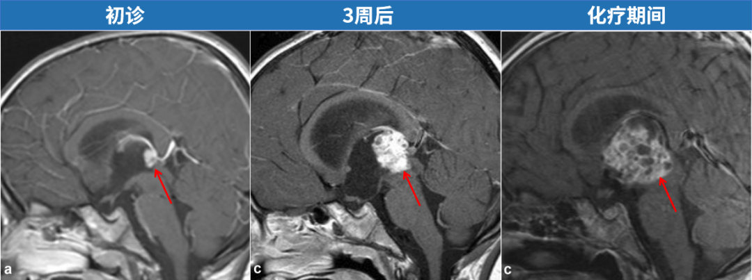 化疗、手术、新疗法轮番上阵，可孩子脑中的怪瘤却丝毫不受影响，甚至越长越大