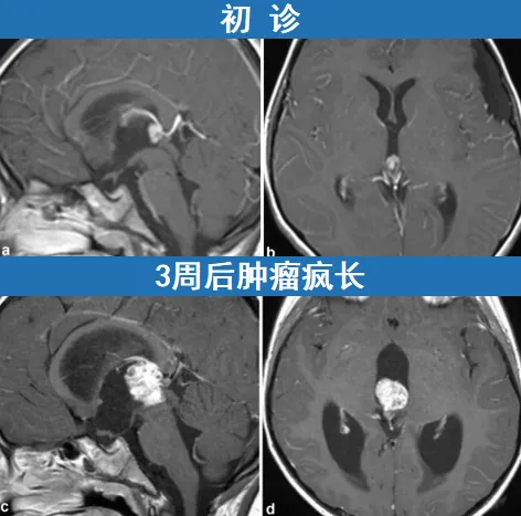 短短8天后，KK的症状急剧恶化
