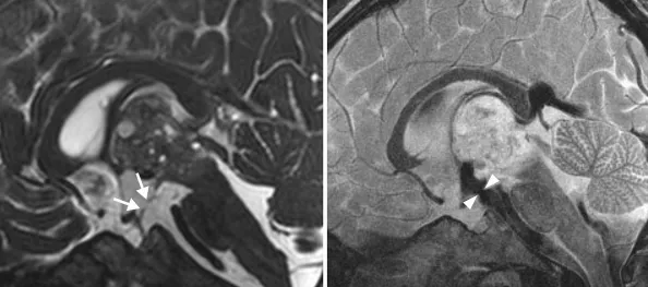 医生先移除了外部引流管，并进行了内镜下第三脑室造瘘术（ETV）和隔膜造口术，成功治疗脑积水。