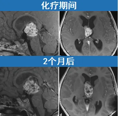 即使KK经历了大剂量化疗和干细胞移植，但肿瘤仍在增大。