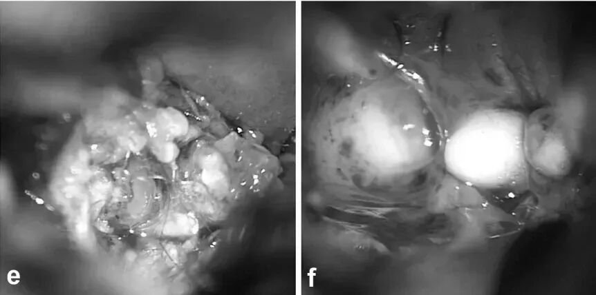我们在他的肿瘤中发现了头发和牙齿样的物质，这提示我们这是畸胎瘤。