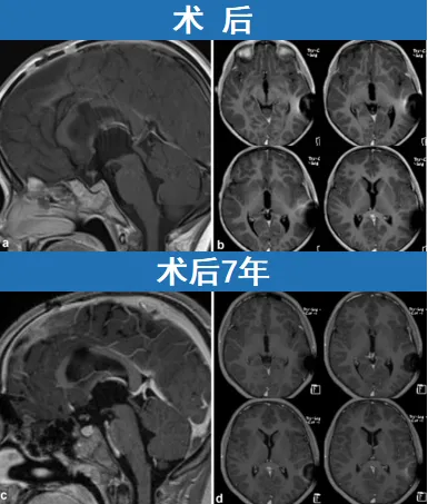 7年后的随访显示他健康如常，无复发迹象