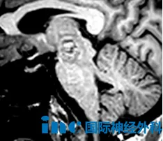 右眼上睑下垂，复视，视野受限，左侧肢体无力，且病变面临再出血风险。