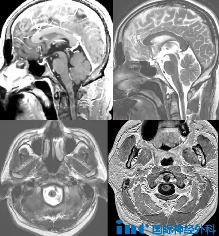 12月底的MRI检查带来了明确诊断，也带来了新的抉择：延髓区海绵状血管瘤。面对这个紧贴生命中枢的“不速之客”，多家医院都因手术风险太高建议保守治疗。