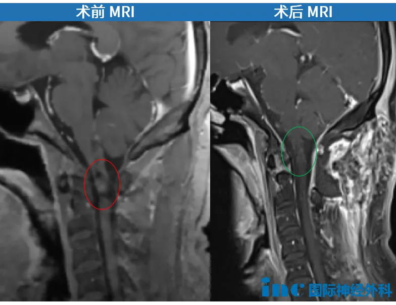 术后第1天，郑先生就顺利转出 ICU。术后部分功能也在好转。术后一年，郑先生早已回到正常生活，甚至能偶尔运动健身。