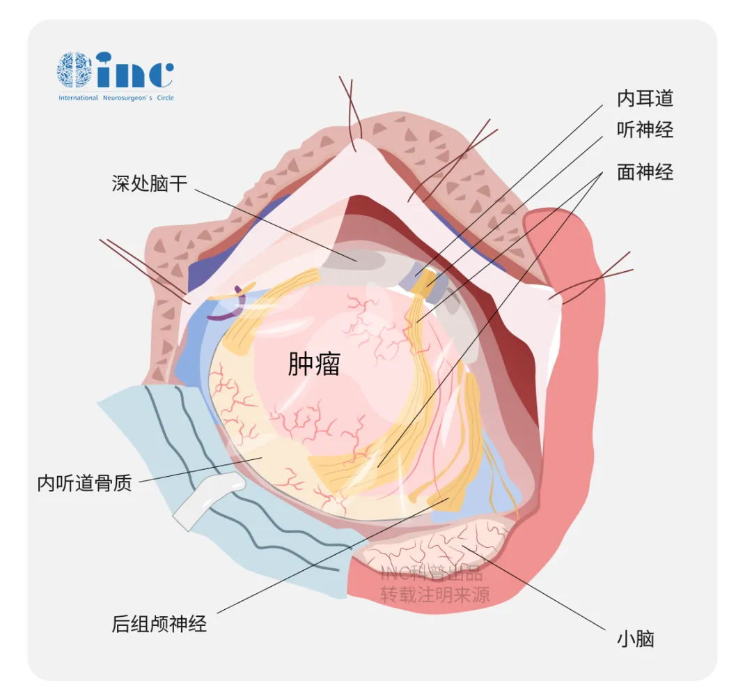 听神经和面神经相距很近