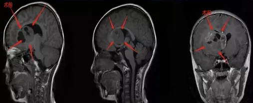 肿瘤在基底节区，足足有50*41*37mm这么大