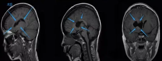 手术十分成功，肿瘤几乎全切