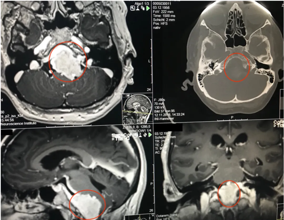 术前MR示：岩斜区巨大脑膜瘤，压迫脑干、颅神经，侵犯基底动脉等