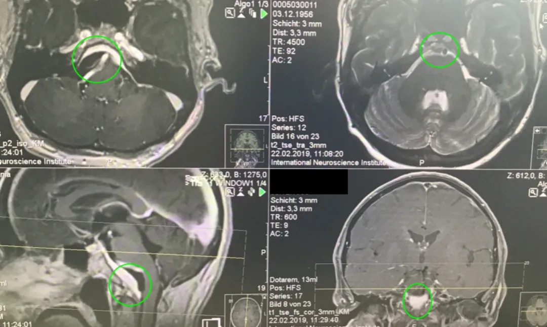 术后MR显示：肿瘤近全切除，术后未见脑血肿、脑水肿，神经血管、脑干等组织保护完好