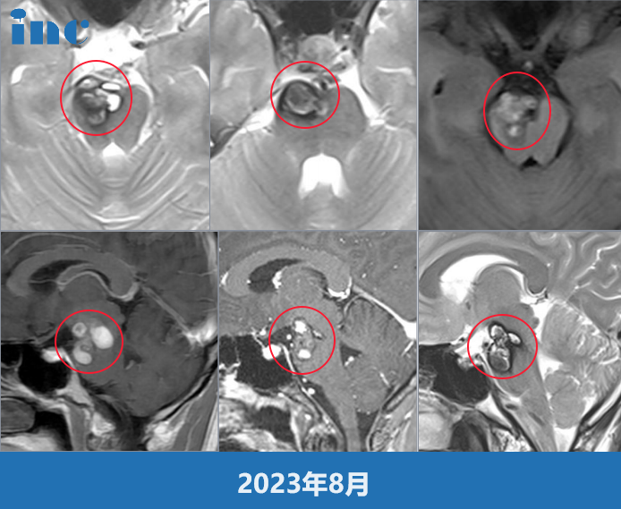 中脑脑桥占位伴多发出血，考虑海绵状血管瘤继发出血。大概率要偏瘫，不偏瘫才是奇迹。这个肿瘤长在了核心的位置，再好的医生也不能给你做，把这个危险避免掉，就是很难。