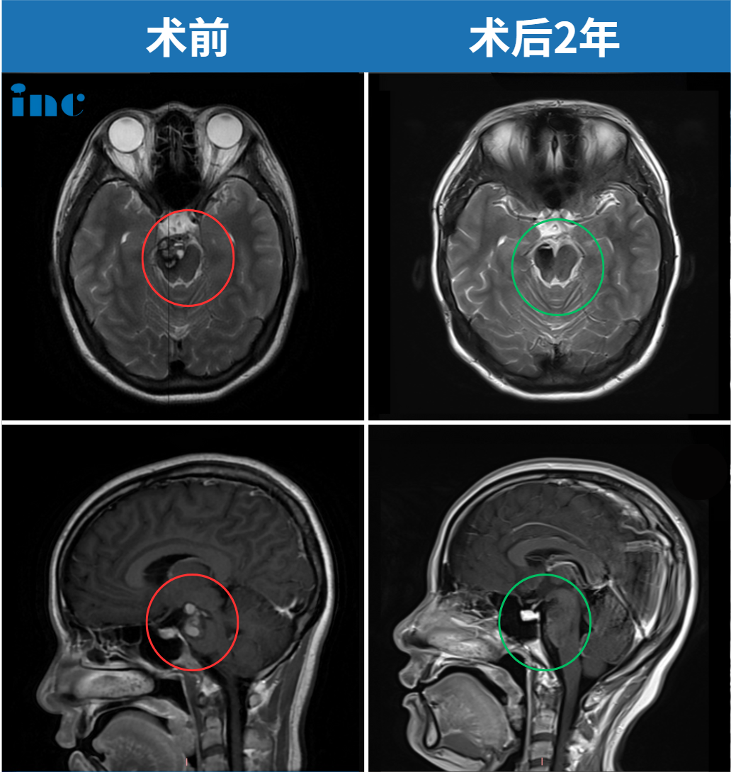 一年半后健康平安诞下宝宝，术后2年一切良好