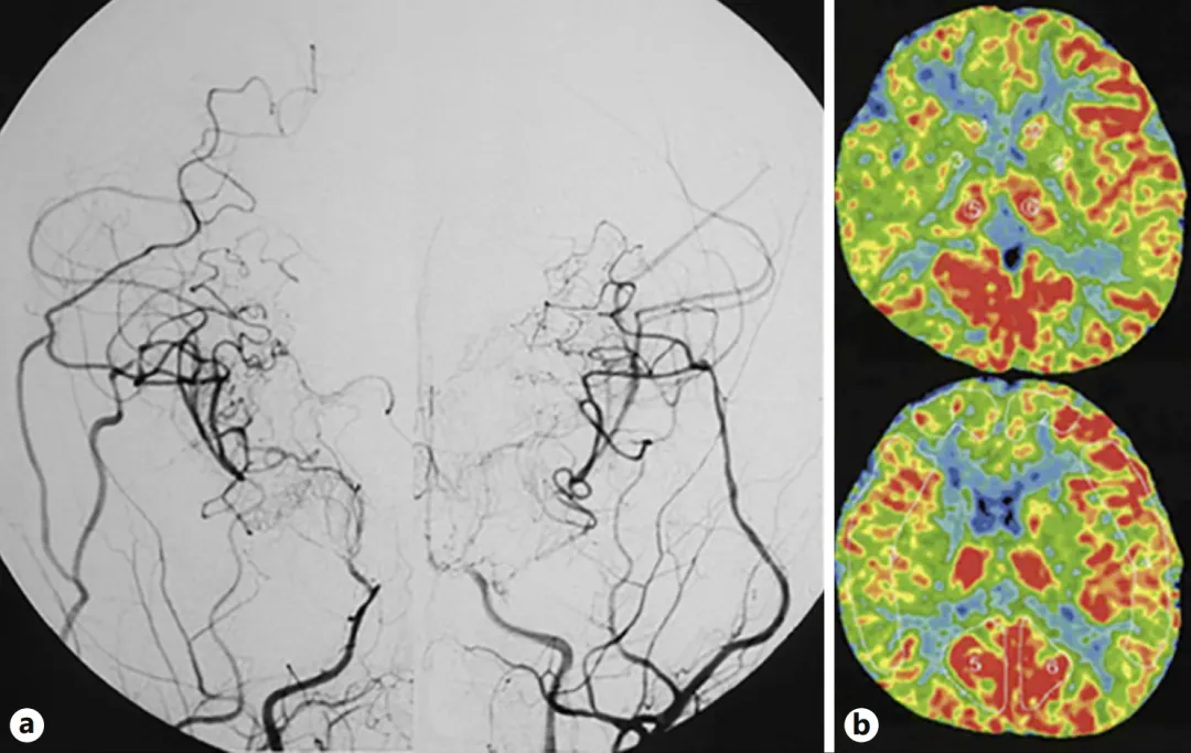 图a：第二次手术半年后，双侧颈内动脉血管造影显示侧支血管网络发育良好，基底烟雾血管消退。  图b：双侧脑血流显示有所改善。