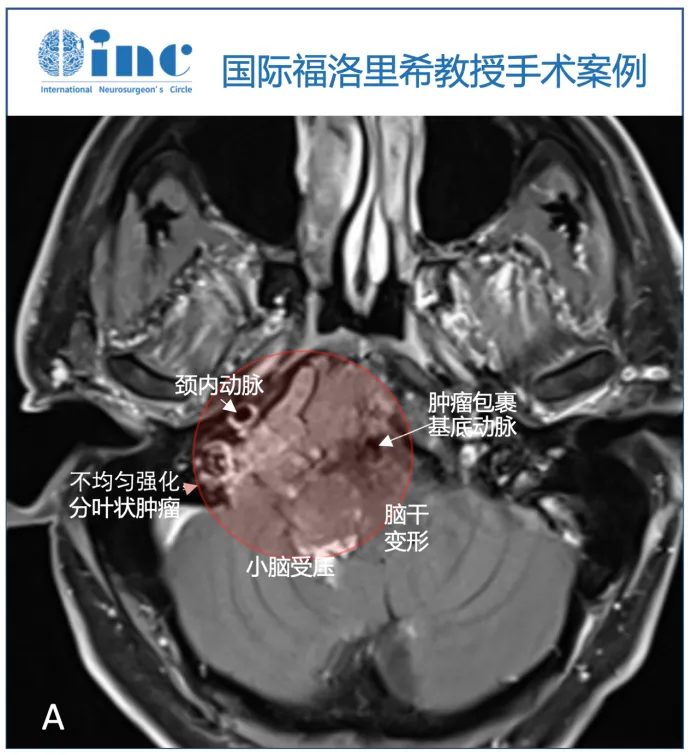 术前MRI显示轴内-轴外肿瘤，累及斜坡和颅颈交界处，压迫脑干致脑干移位，为不均匀增强