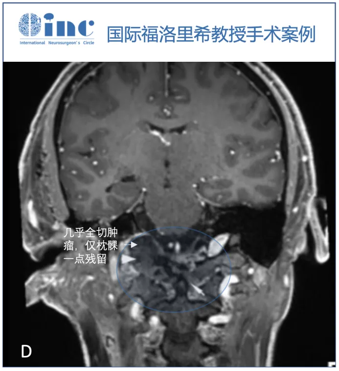 D：术后MRI显示齿状突外侧有一小块残留肿瘤(白色箭头)。自体脂肪用于清除死区(箭头)