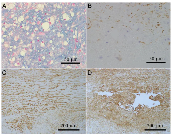 在显微镜下，医生们发现了中膜平滑肌细胞排列紊乱、数量减少，还有黏液样物质在细胞外基质中异常积聚。这些发现提示患者的血管壁本身存在脆弱性。
