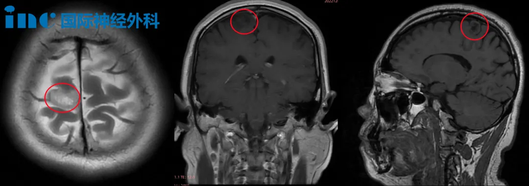 亲诉战胜肿瘤这一路的经历 ”我觉得重新定义了生命的意义“