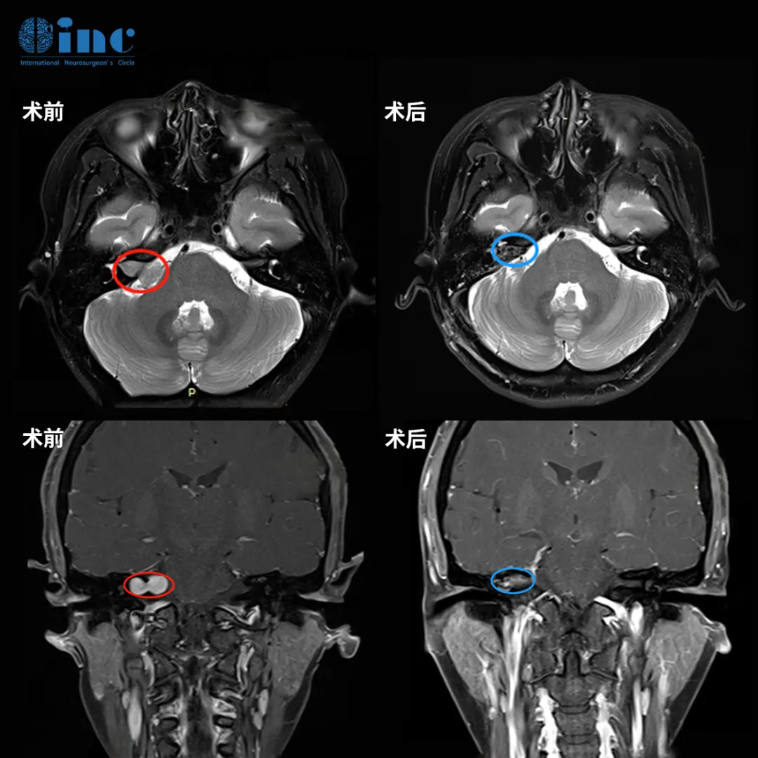 肿瘤被完全切除，面神经也成功保留。姜女士醒来后第一件事就是确认自己的面部功能，当发现一切正常时，她心中的巨石终于落地。
