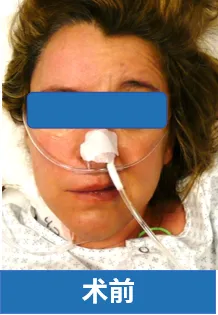 吞咽困难,我连一口水都咽不下去,一根鼻饲管成了我活下去的通道,维持我的营养。