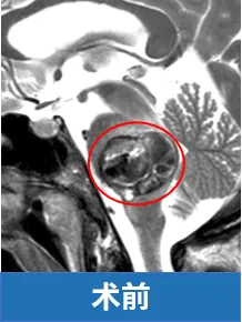 病灶长在“手术禁区”,脑桥那个地方,病变已经把桥脑撑的像个气球。