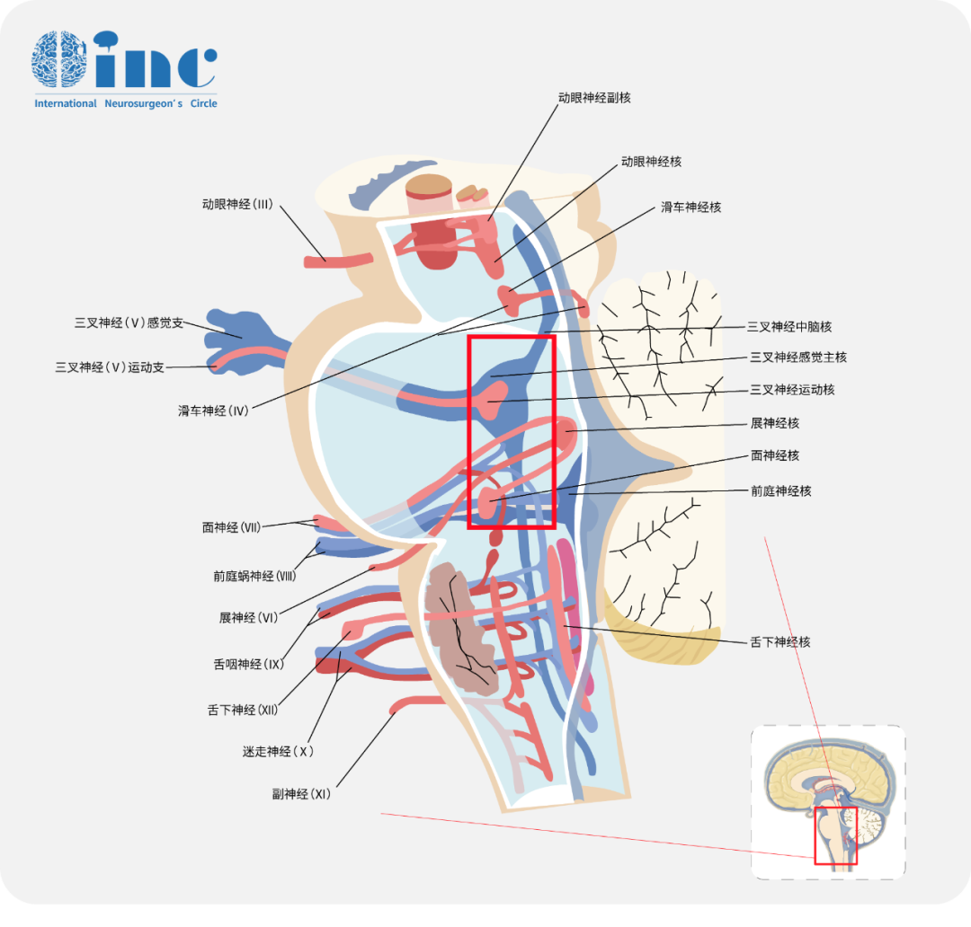 脑桥深部还分布有网状结构等生命中枢,对维持意识清醒、睡眠节律和呼吸功能具有重要作用。由于脑桥结构极为复杂,手术操作常需毫米级精度,过去一直被视为“手术禁区”。