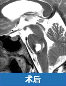 术后一年,明显可以看到我的面神经和外展神经功能已基本恢复